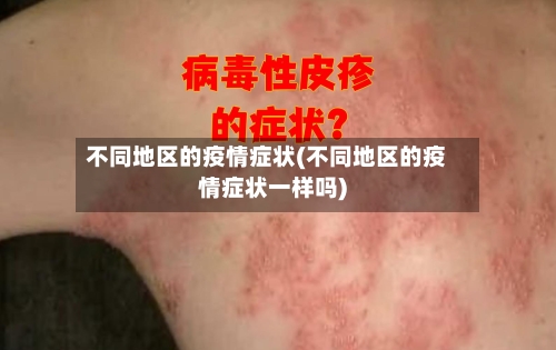 不同地区的疫情症状(不同地区的疫情症状一样吗)-第1张图片